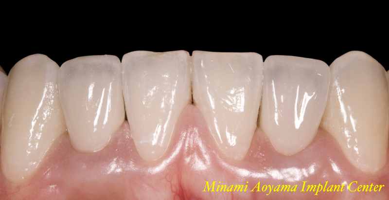 下顎前歯先天欠損症例 症例写真3