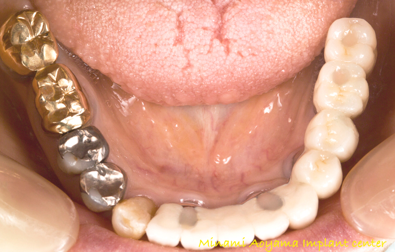 インプラントによる全顎的な審美と機能の改善例1 症例写真8