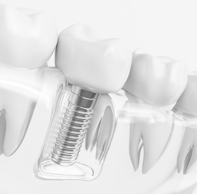 インプラントによる治療