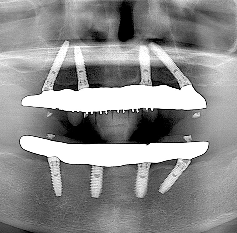インプラント症例