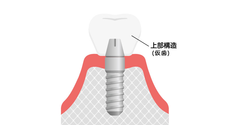 インプラント:フィクスチャー埋入