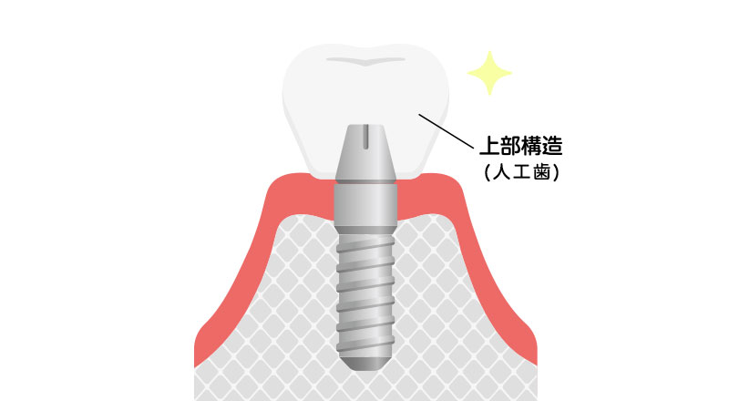 義歯(入れ歯)や補綴物(人工歯)を作る