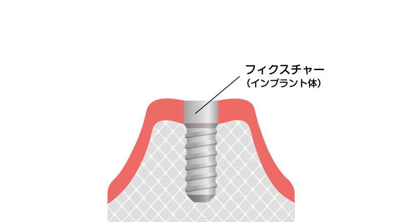 インプラント:フィクスチャー埋入